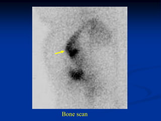 Bone scan
 