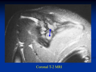 Coronal T-2 MRI
 
