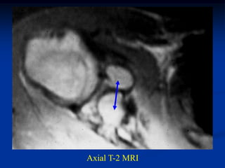 Axial T-2 MRI
 