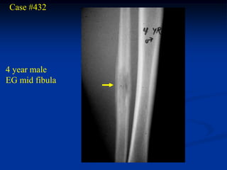 Case #432




4 year male
EG mid fibula
 