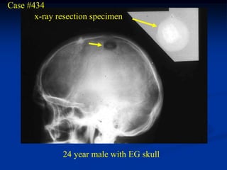 Case #434
       x-ray resection specimen




              24 year male with EG skull
 