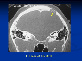 CT scan of EG skull
 