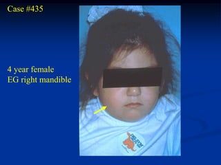 Case #435




4 year female
EG right mandible
 