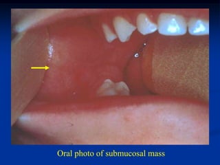 Oral photo of submucosal mass
 