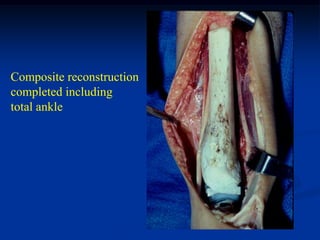 Composite reconstruction
completed including
total ankle
 