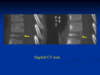 Sagittal CT scan
 