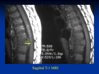 Sagittal T-1 MRI
 