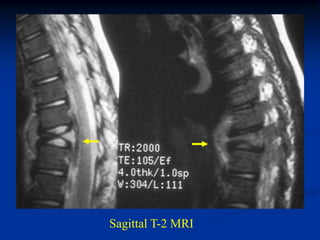 Sagittal T-2 MRI
 