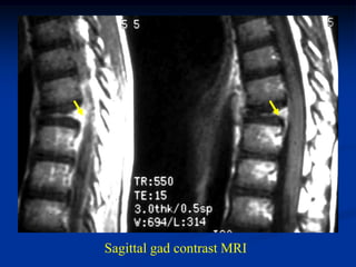 Sagittal gad contrast MRI
 