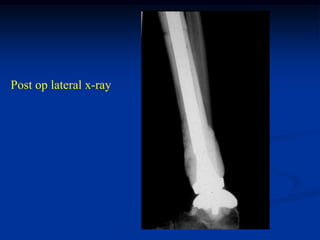 Post op lateral x-ray
 