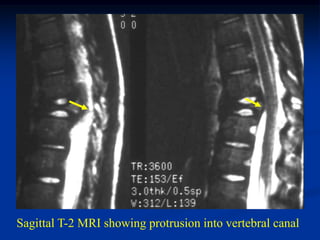 Sagittal T-2 MRI showing protrusion into vertebral canal
 
