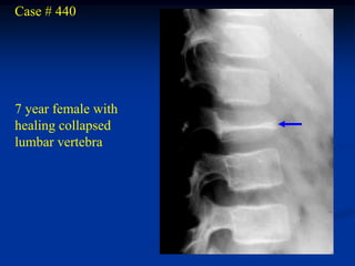 Case # 440




7 year female with
healing collapsed
lumbar vertebra
 