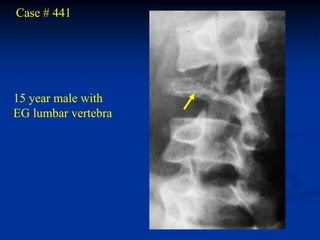 Case # 441




15 year male with
EG lumbar vertebra
 