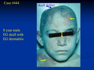 Case #444
                skull defect




8 year male
EG skull with
EG dermatitis
 