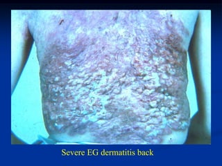 Severe EG dermatitis back
 