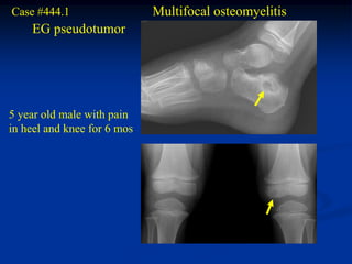 Case #444.1                  Multifocal osteomyelitis
    EG pseudotumor




5 year old male with pain
in heel and knee for 6 mos
 