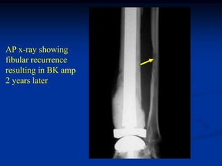 AP x-ray showing
fibular recurrence
resulting in BK amp
2 years later
 