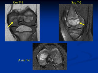 Cor T-1        Sag T-2




   Axial T-2
 