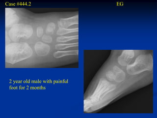 Case #444.2                     EG




 2 year old male with painful
 foot for 2 months
 