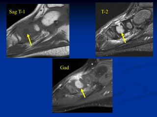 Sag T-1         T-2




          Gad
 