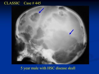 CLASSIC    Case # 445




          5 year male with HSC disease skull
 