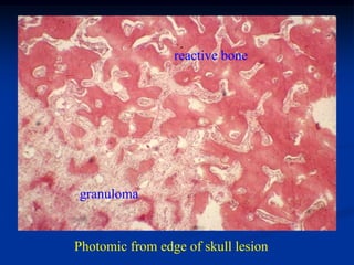 reactive bone




granuloma


Photomic from edge of skull lesion
 