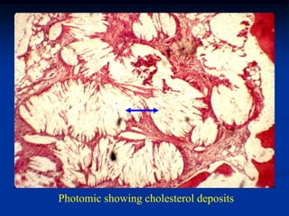 Photomic showing cholesterol deposits
 