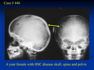 Case # 446




 6 year female with HSC disease skull, spine and pelvis
 