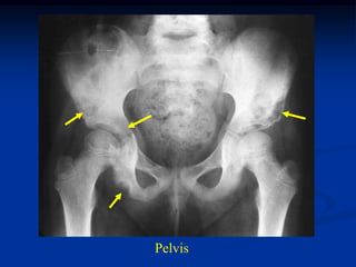 Pelvis
 
