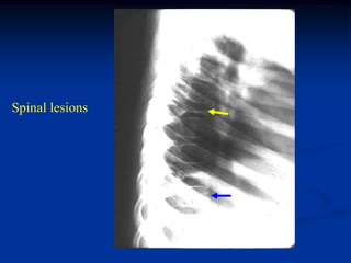 Spinal lesions
 