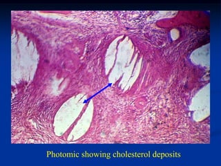 Photomic showing cholesterol deposits
 