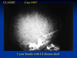 CLASSIC         Case #447




          3 year female with LS disease skull
 