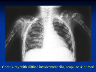 Chest x-ray with diffuse involvement ribs, scapulae & humeri
 