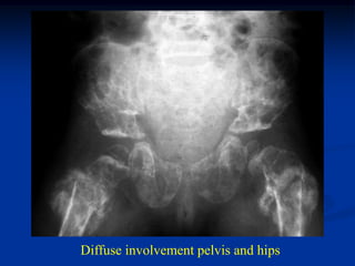 Diffuse involvement pelvis and hips
 