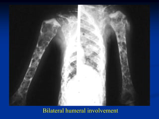 Bilateral humeral involvement
 