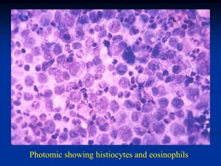Photomic showing histiocytes and eosinophils
 