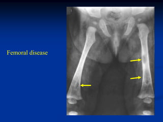 Femoral disease
 