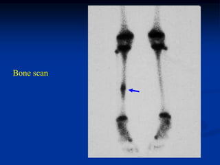 Bone scan
 
