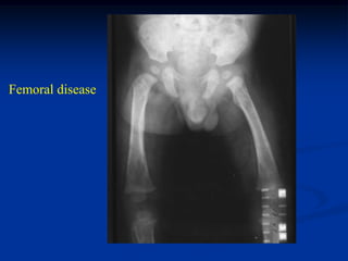 Femoral disease
 