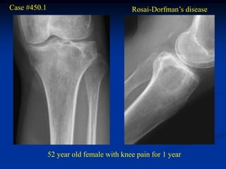 Case #450.1                              Rosai-Dorfman’s disease




              52 year old female with knee pain for 1 year
 