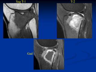 Sag T-1         T-2




          Gad
 