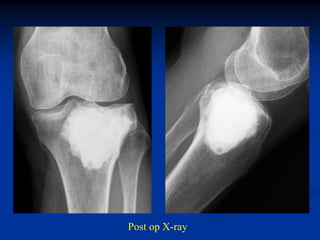 Post op X-ray
 