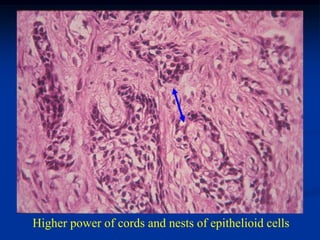 Higher power of cords and nests of epithelioid cells
 