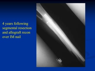 4 years following
segmental resection
and allograft recon
over IM nail
 