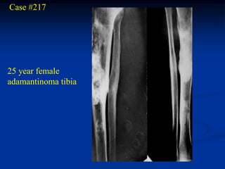 Case #217




25 year female
adamantinoma tibia
 
