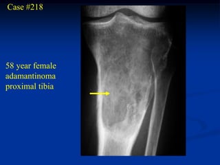 Case #218




58 year female
adamantinoma
proximal tibia
 