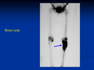 Bone scan
 