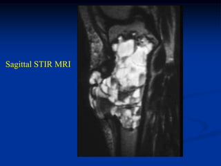 Sagittal STIR MRI
 