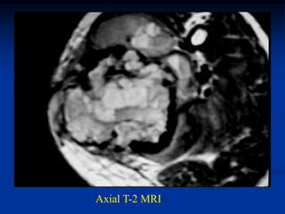 Axial T-2 MRI
 