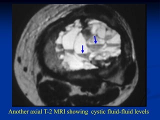 Another axial T-2 MRI showing cystic fluid-fluid levels
 